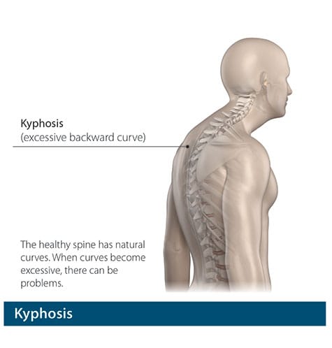 Professional kyphosis treatment at Spine-X Chiropractic
