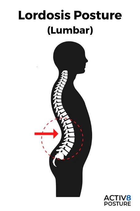 Professional lordosis treatment at Spine-X Chiropractic