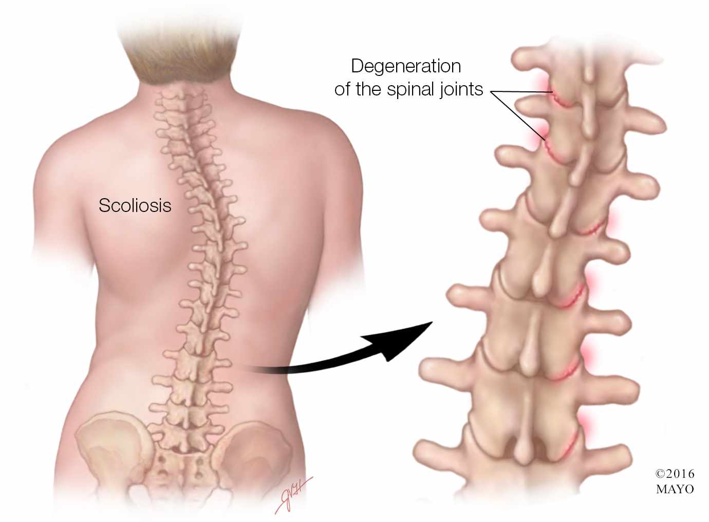Professional scoliosis treatment at Spine-X Chiropractic