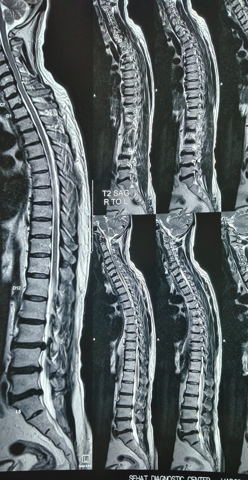 Spinal alignment therapy session at Spine-X Chiropractic