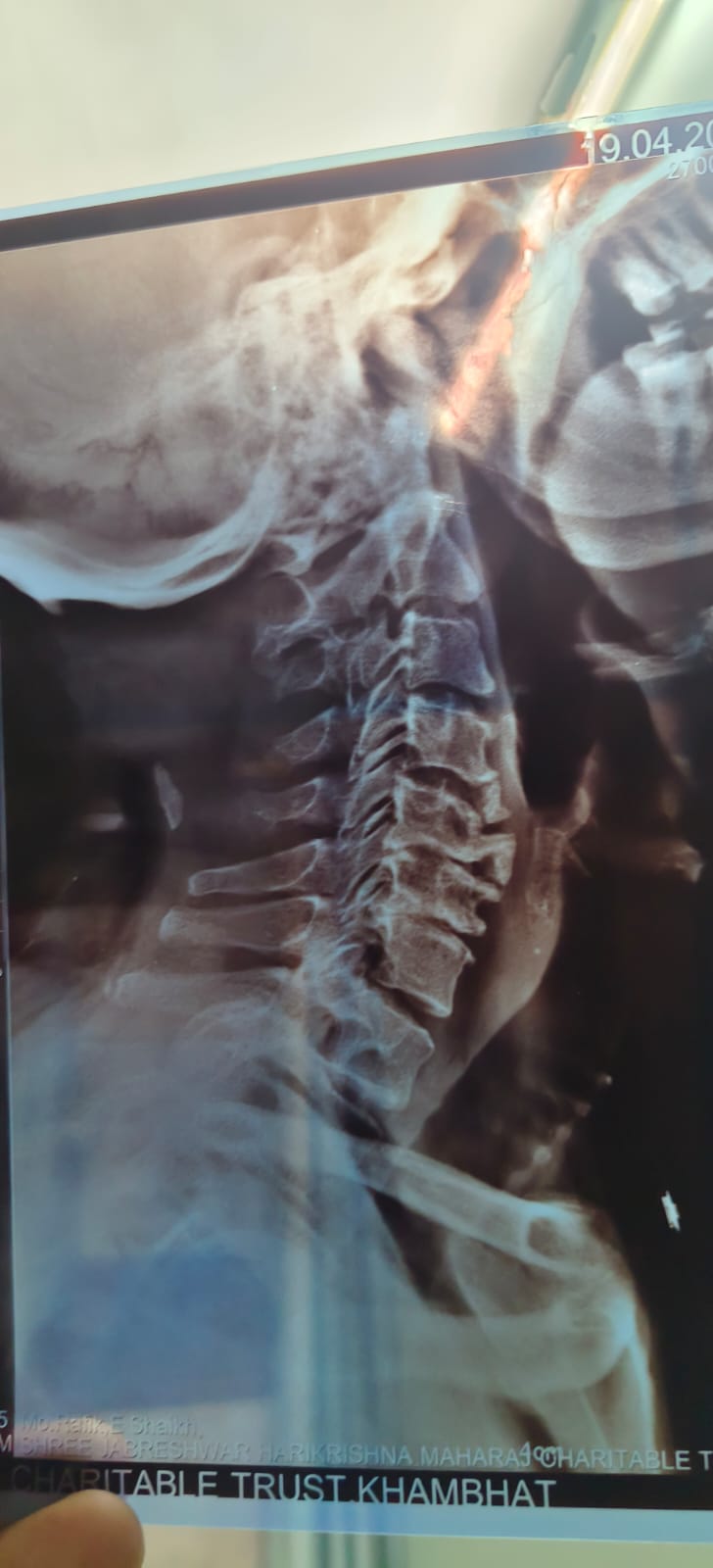 Patient undergoing posture assessment at Spine-X Chiropractic