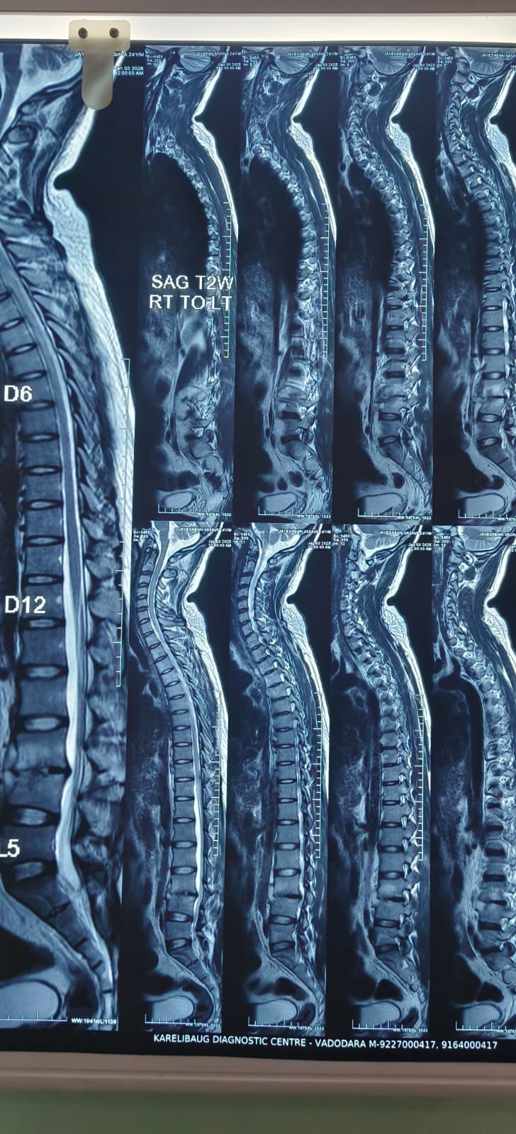 Joint mobilization therapy at Spine-X Chiropractic clinic