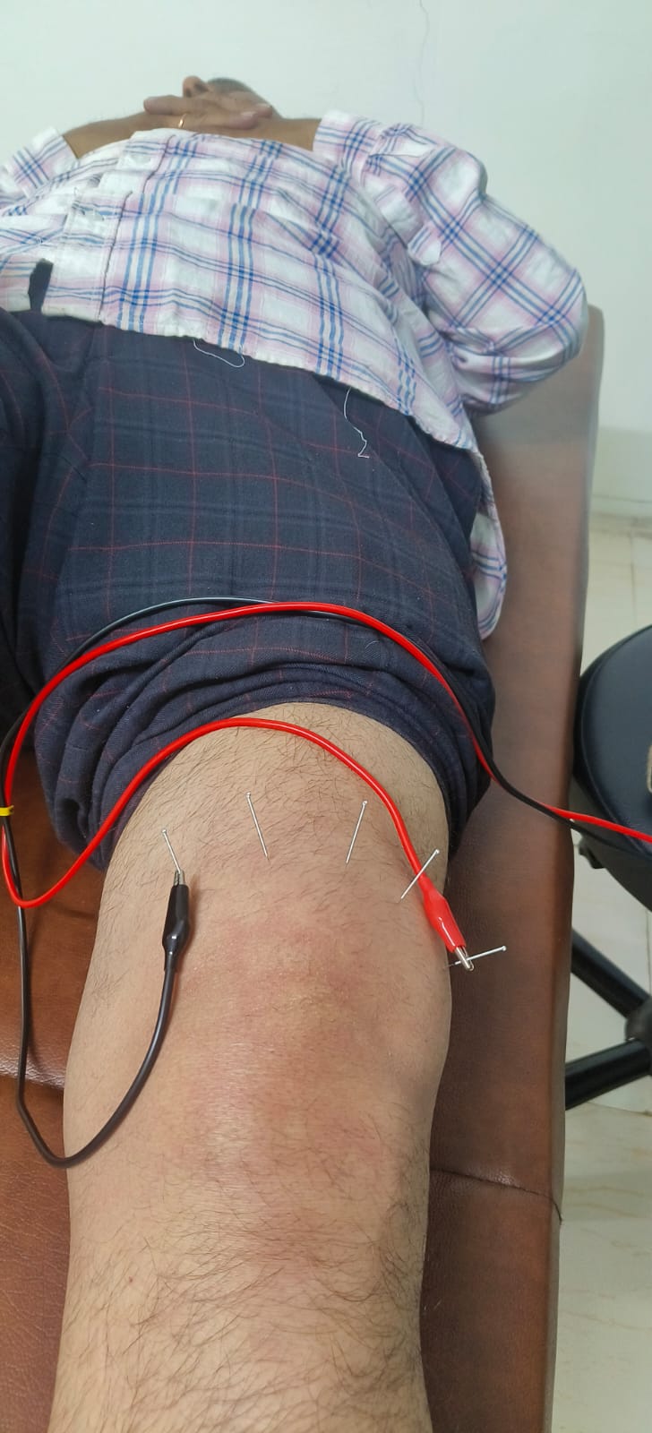 Cupping therapy treatment at Spine-X Chiropractic for muscle tension